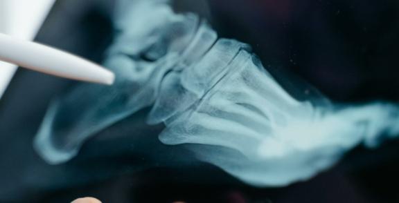 Healthcare 2 min Close-up of a foot X-ray with a pointer near the toes